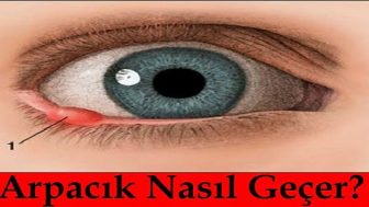 Gözde Çıkan Arpacık Nasıl Geçer Ne İyi Gelir