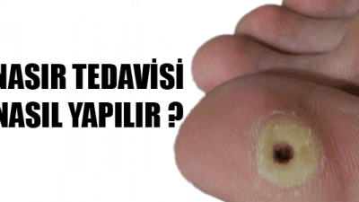 Nasıra Ne İyi Gelir?