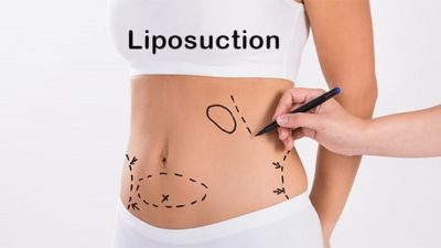 Devlet Hastanesinde Yağ Aldırma Fiyatları